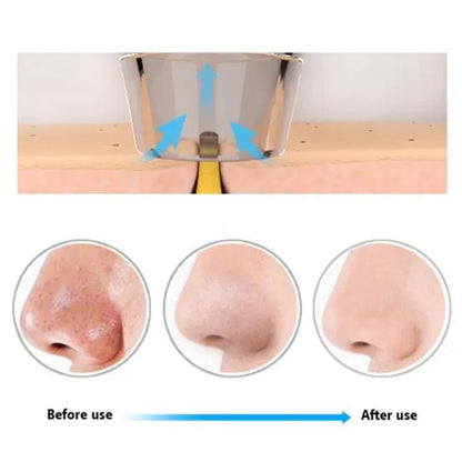 Blackheads, Whiteheads & Face Pores Cleaner & Suction Machine